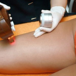 La Depilación Láser. Beneficios y Resultados