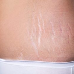 ¿Qué Son las Estrías? Causas, Síntomas y Tratamientos