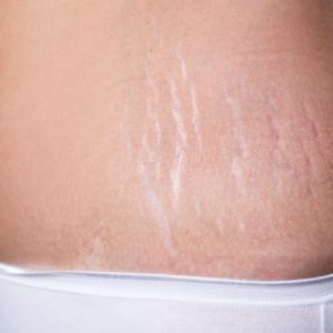 ¿Qué Son las Estrías? Causas, Síntomas y Tratamientos