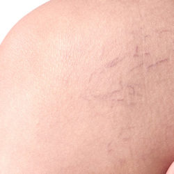 Varices y Arañas Vasculares. Consejos y Tratamientos