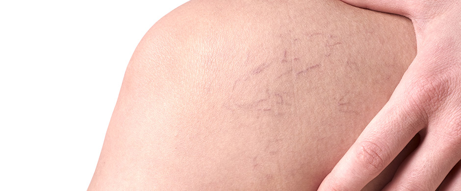 Varices y Arañas Vasculares