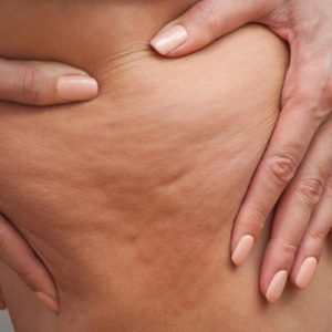 ¿Qué es la Celulitis? Causas y Tratamientos